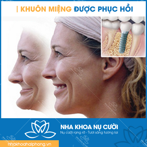 loi-ich-cua-trong-rang-Implant