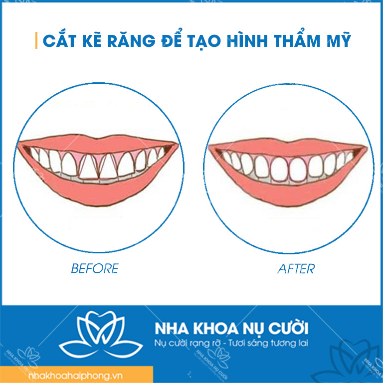nhung-truong-hop-nen-mai-ke-rang