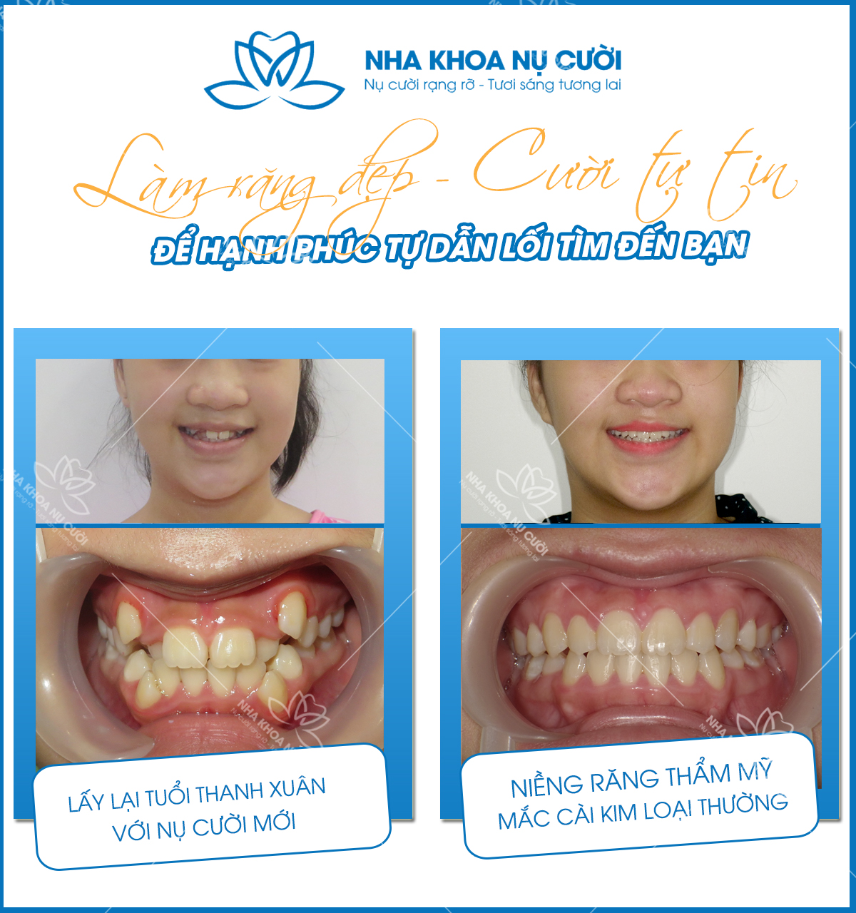 nhung-loi-ich-tuyet-voi-cua-nieng-rang-tham-my