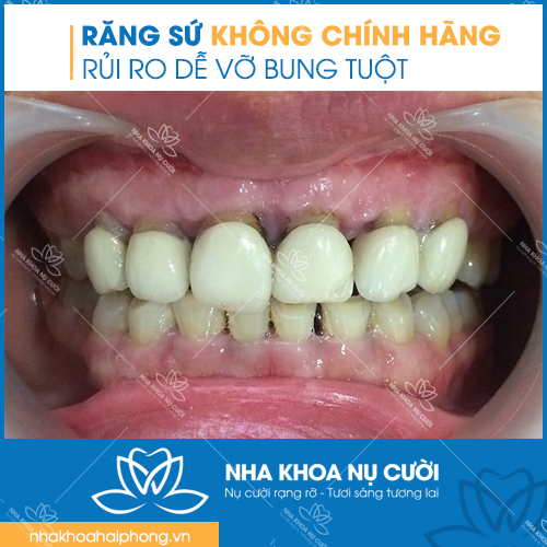 rang-su-khong-chinh-hang