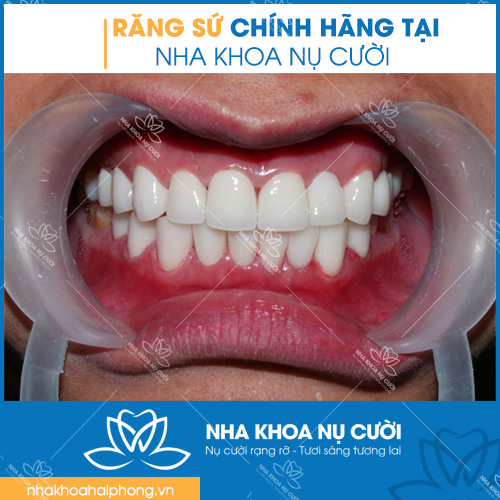 rang-su-chinh-hang