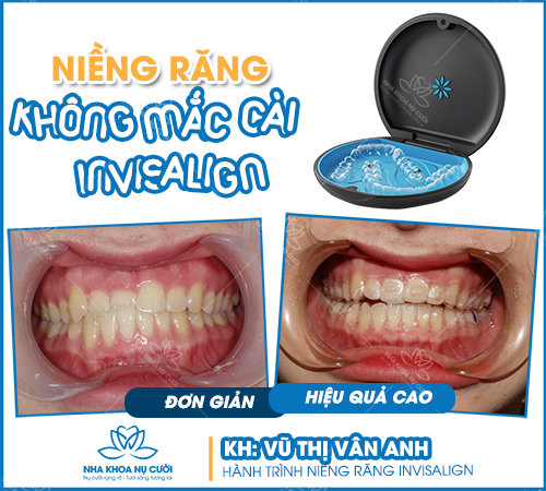 uu-diem-cua-nieng-rang-thao-lap