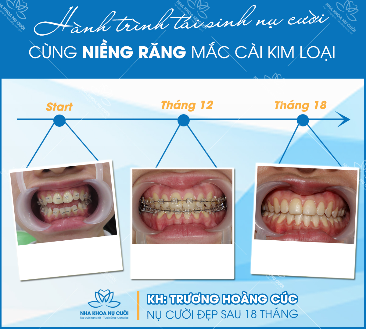 dieu-tri-khop-can-ho-tai-nha-khoa-nu-cuoi