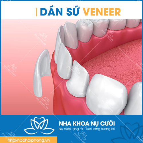 Dan-su-veneer