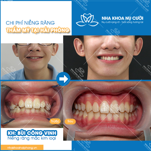 CHI PHÍ NIỀNG RĂNG THẨM MỸ TẠI HẢI PHÒNG – CHỈ TỪ 20 TRIỆU