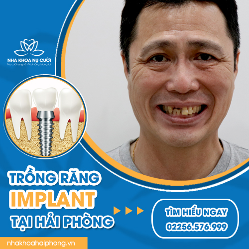 trong-rang-Implant-tai-hai-phong