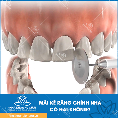 Mài kẽ răng để chỉnh nha có hại không? Khi nào cần thực hiện?