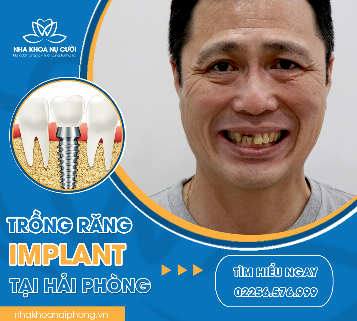 trong-rang-Implant-tai-hai-phong