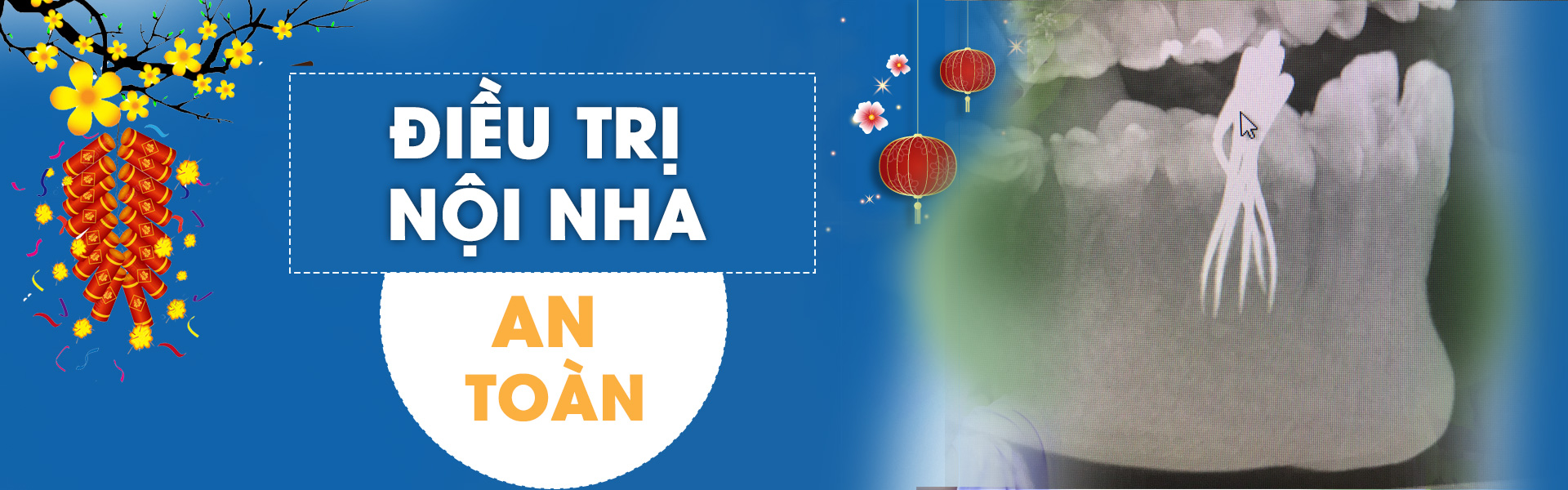 NHA KHOA NỤ CƯỜI CHIA SẺ KINH NGHIỆM ĐIỀU TRỊ TỦY RĂNG