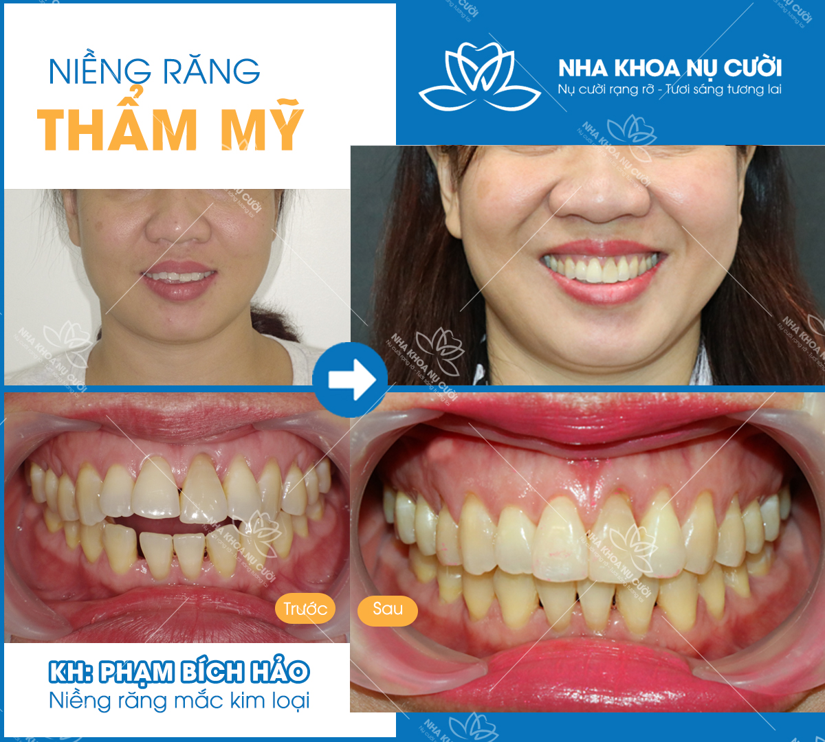 -dieu-tri-khop-can-ho-tai-nha-khoa-nu-cuoi