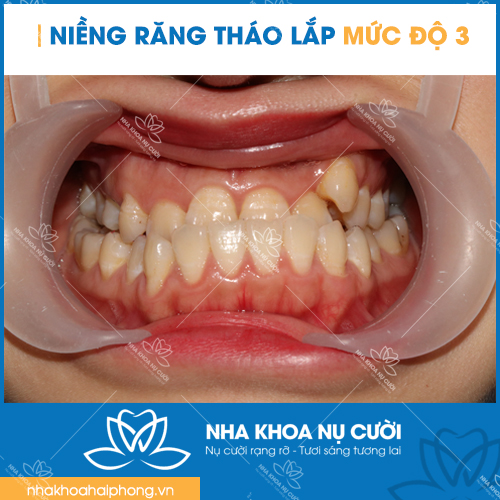nieng-rang-thao-lap-theo-muc-do