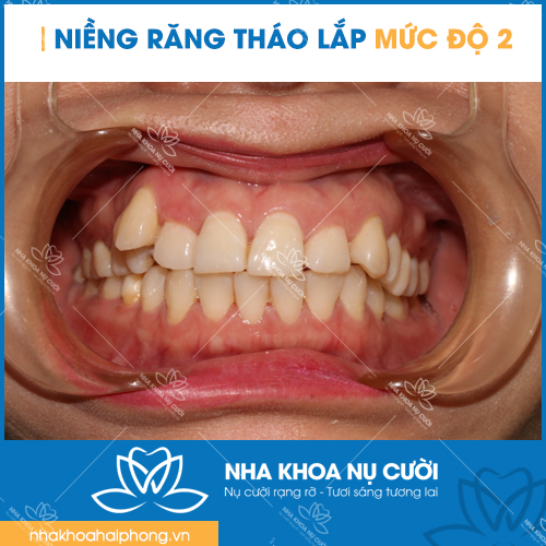 nieng-rang-thao-lap-theo-muc-do