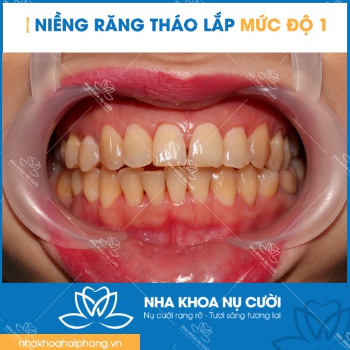 nieng-rang-thao-lap-theo-muc-do