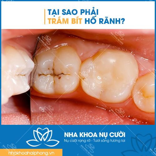 tai-sao-phai-tram-bit-ho-ranh