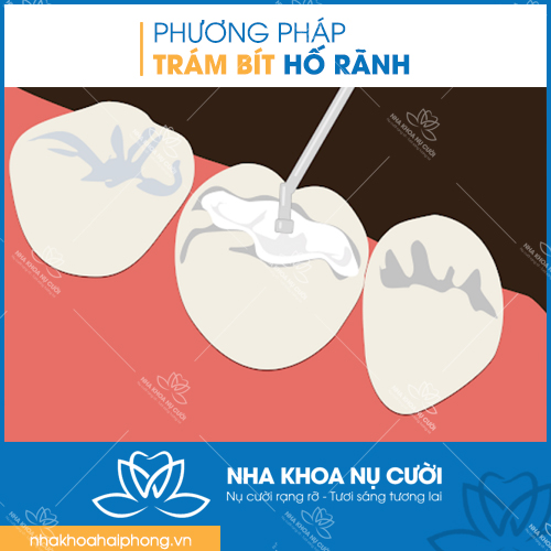 tram-bit-ho-ranh-phong-ngua-sau-rang-hieu-qua-cho-tre