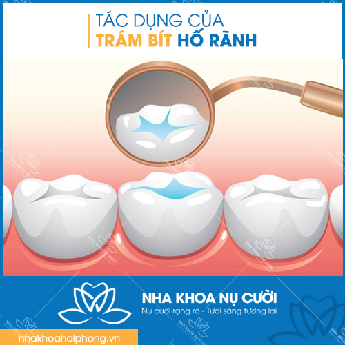 tram-bit-ho-ranh-phong-ngua-sau-rang-hieu-qua-cho-tre