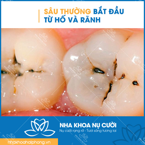 su-hinh-thanh-cua-sau-rang