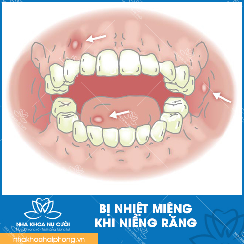 7-KINH-NGHIEM-VE-NIENG-RANG