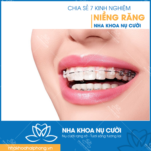 NHA KHOA NỤ CƯỜI CHIA SẺ 7 KINH NGHIỆM NIỀNG RĂNG