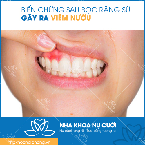 Nhung-bien-chung-sau-khi-boc-rang-su