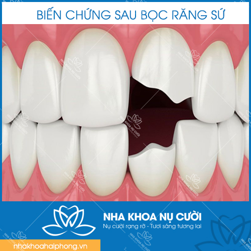 Nhung-bien-chung-sau-khi-boc-rang-su