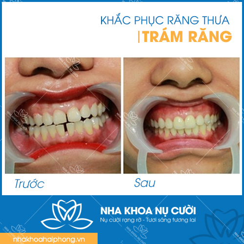 Han-tram-rang