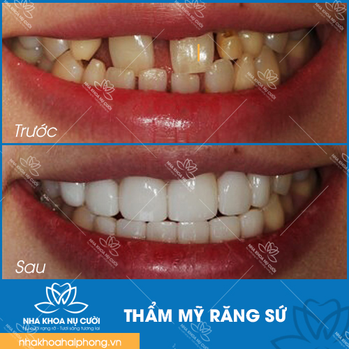 Mach-ban-4-cach-khac-phuc-rang-thua-hieu-qua