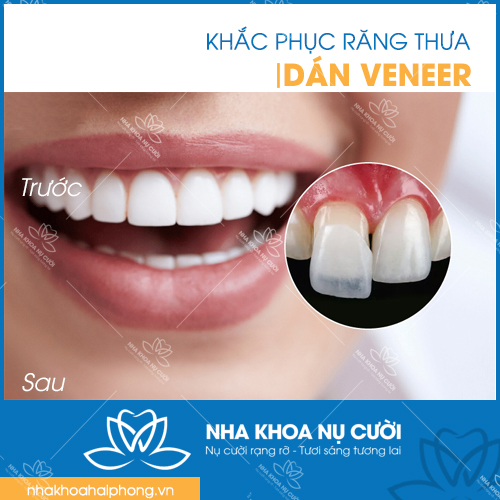 Dan-Veneer