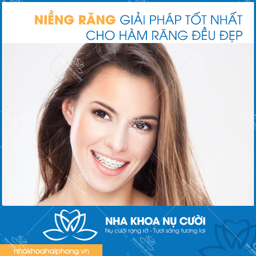 Niềng răng: Phương pháp, quy trình, chi phí và những điều cần biết