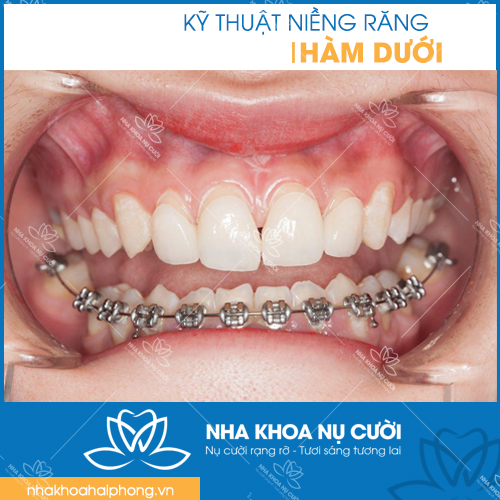 Ky-thuat-nieng-rang-ham-duoi