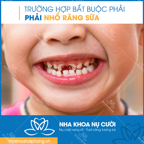 truong-hop-bat-buoc-phai-nho-rang-sua