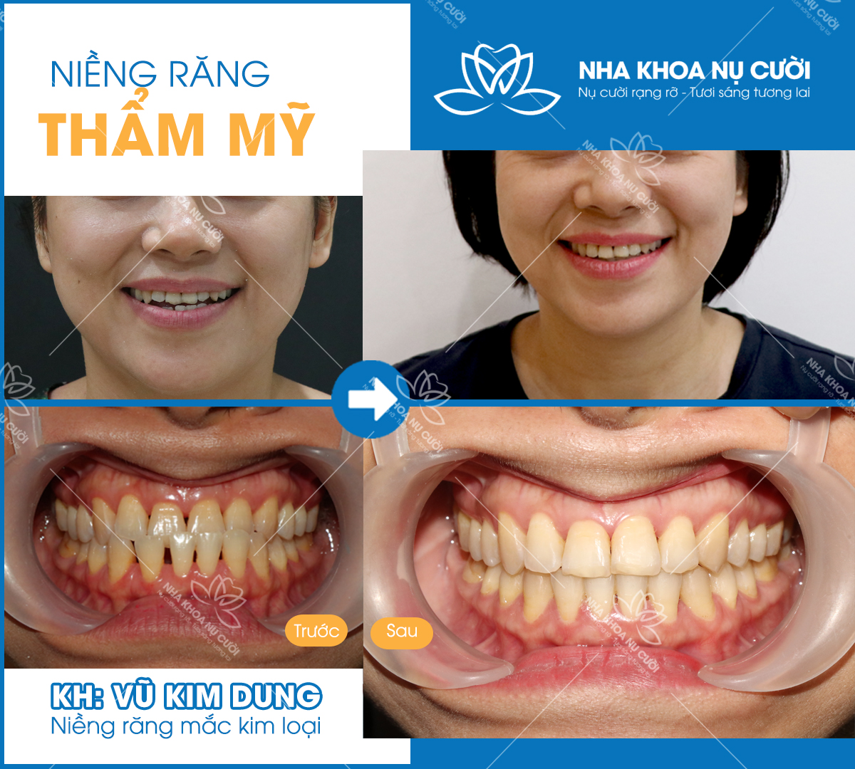 nieng-rang-tham-my