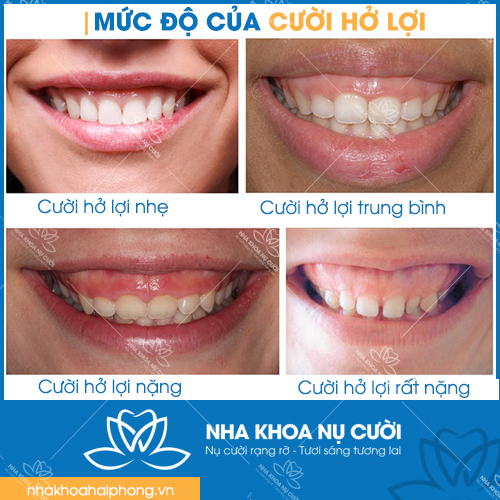muc-do-co-ban-cua-cuoi-ho-loi