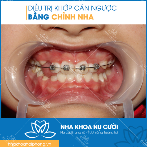 ĐIỀU TRỊ KHỚP CẮN NGƯỢC CHO TRẺ EM