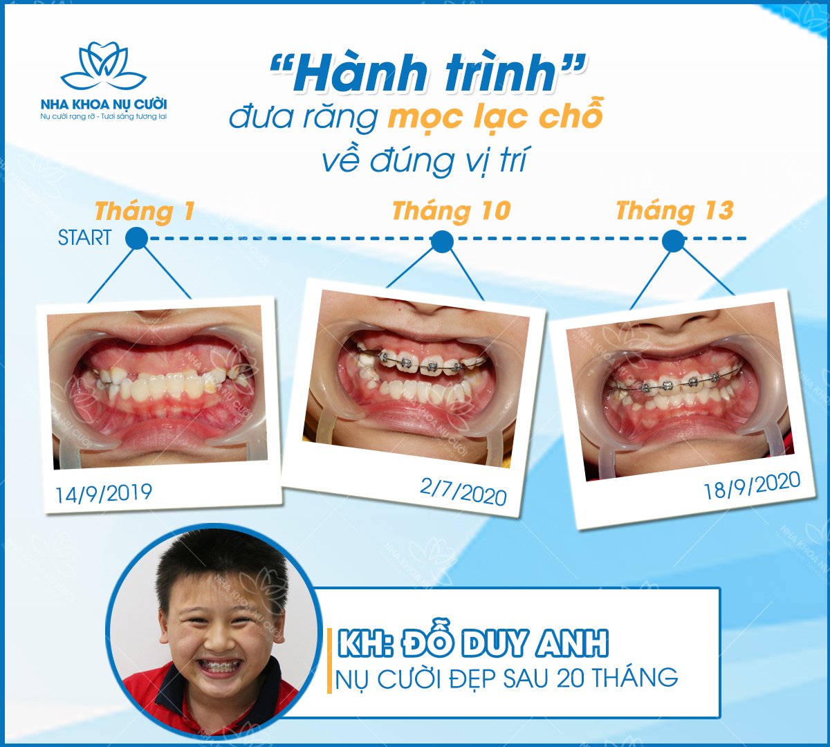 dieu-tri-khop-can-nguoc-o-tre