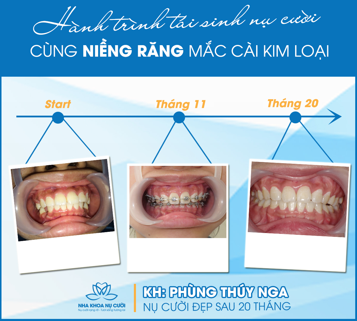 NIENG-RANG-THAM-MY-KHAC-PHUC-TINH0TRANG-RANG-HO