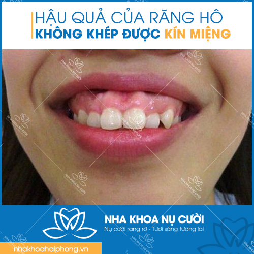 NIENG-RANG-THAM-MY-KHAC-PHUC-TINH0TRANG-RANG-HO