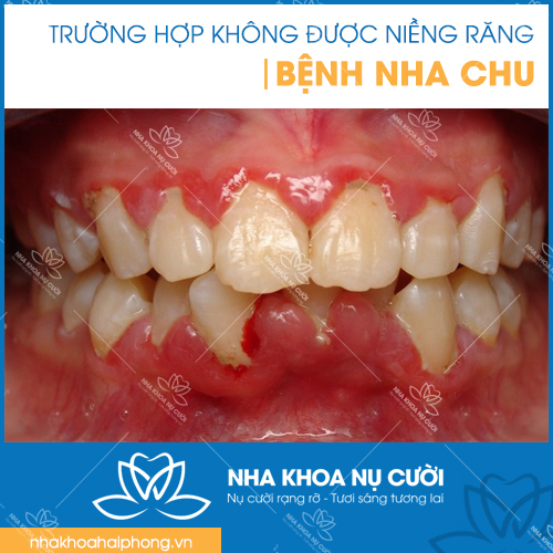 3-truong-hop-khong-duoc-nieng-rang-tham-my
