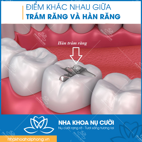 diem-khac-nhau-giua-tram-rang-và-han-rang