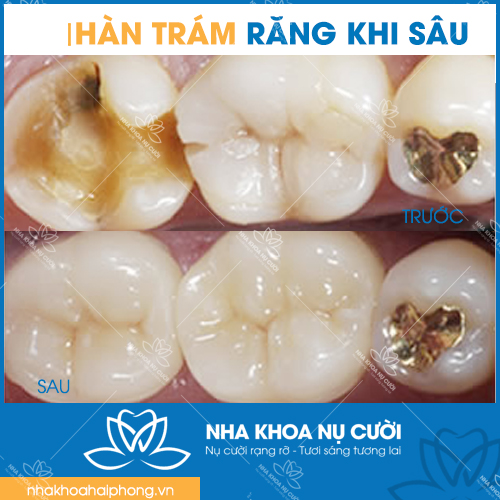 diem-khac-nhau-giua-tram-rang-và-han-rang
