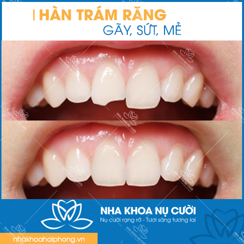 diem-khac-nhau-giua-tram-rang-và-han-rang