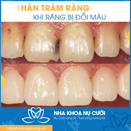 diem-khac-nhau-giua-tram-rang-và-han-rang