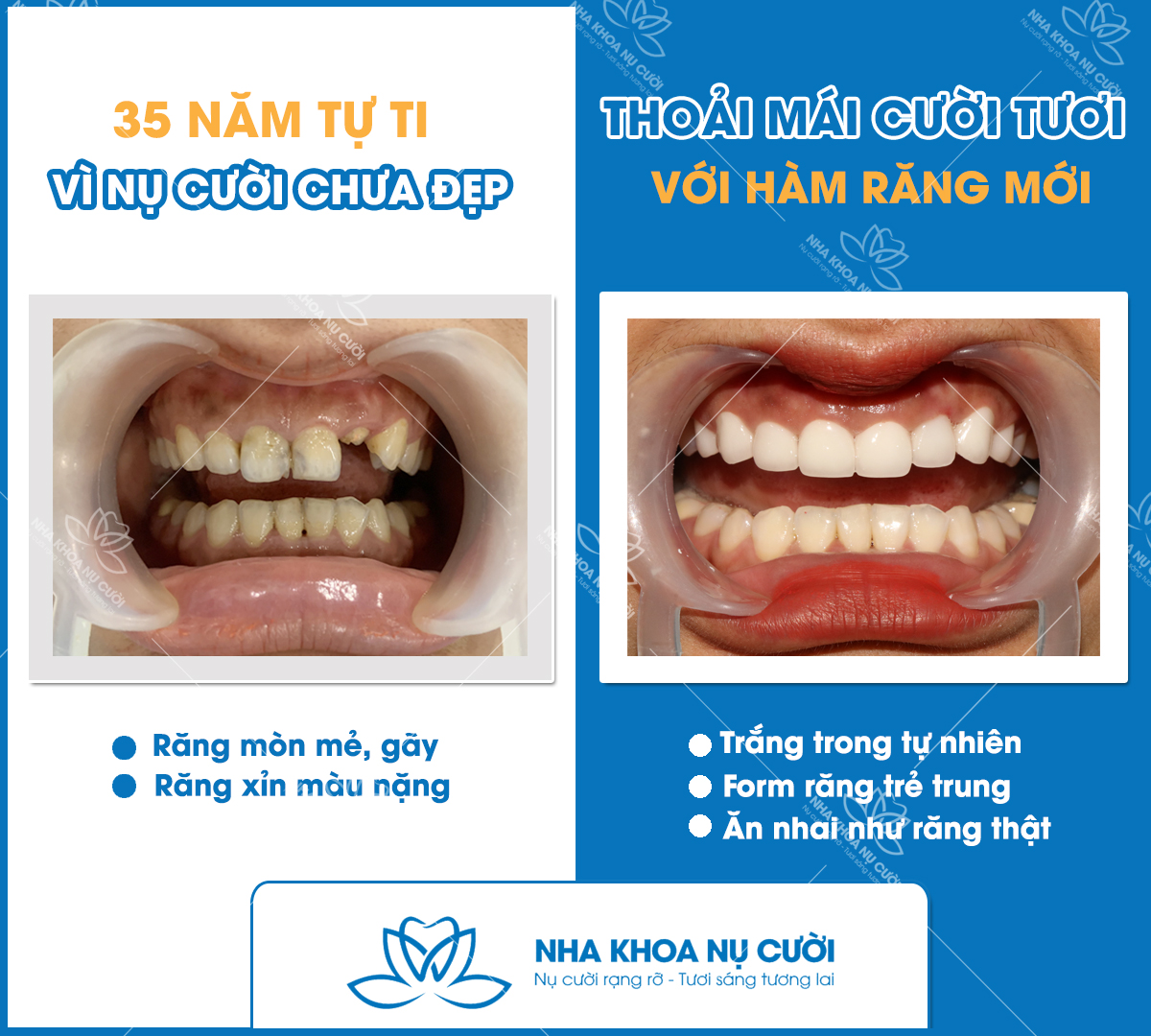 boc-chup-rang-su-tham-my-tai-Hai-Phong