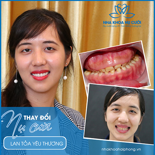 CHỮA CƯỜI HỞ LỢI TẠI HẢI PHÒNG