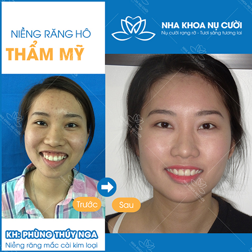 NIỀNG RĂNG THẨM MỸ KHẮC PHỤC TÌNH TRẠNG RĂNG HÔ