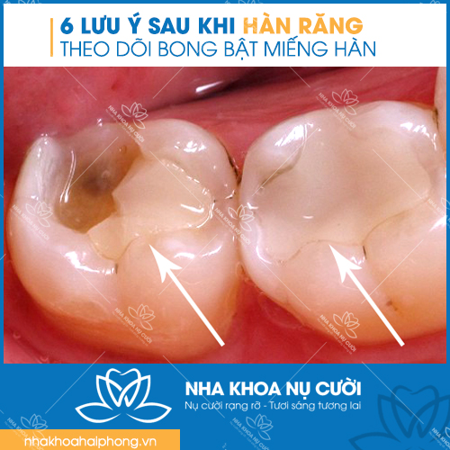 6-luu-y-quan-trong-sau-khi-han-rang