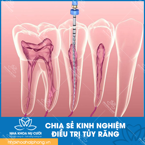 NHA KHOA NỤ CƯỜI CHIA SẺ KINH NGHIỆM ĐIỀU TRỊ TỦY RĂNG