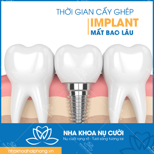 thoi-gian-cay-ghep-Implant-mat-bao-lau