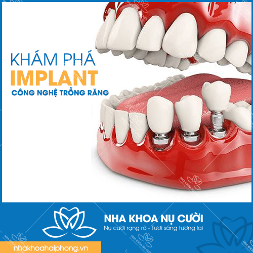 KHÁM PHÁ CÔNG NGHỆ TRỒNG RĂNG IMPLANT HIỆN ĐẠI