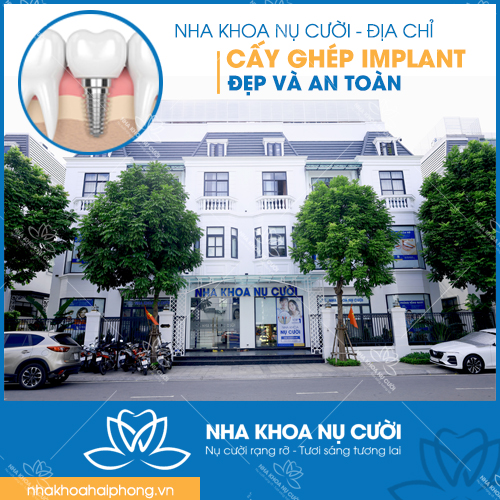 NHA KHOA NỤ CƯỜI – NƠI CẤY GHÉP IMPLANT ĐẸP VÀ AN TOÀN